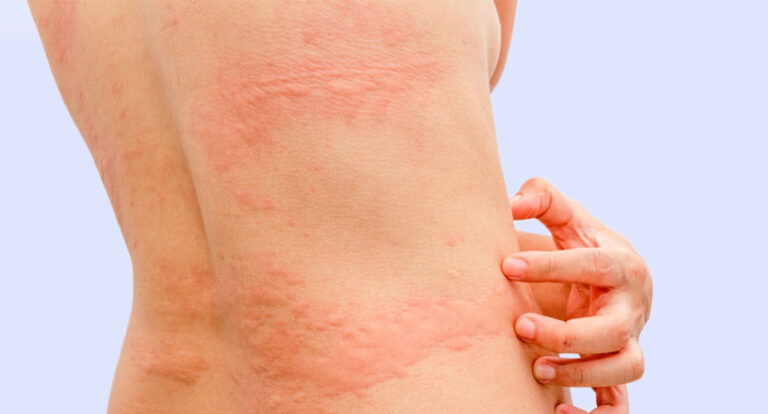 urticaria-imagem-fotos