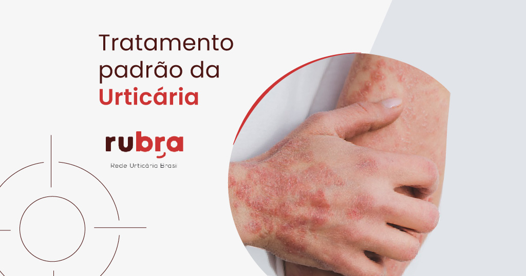 tratamento-padrao-urticaria-rubra