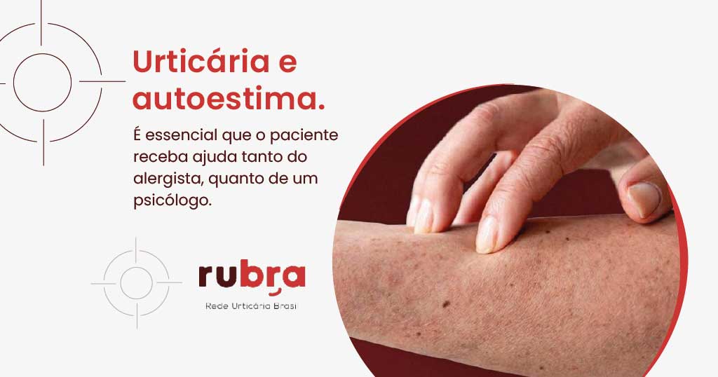 urticaria-e-autoestima