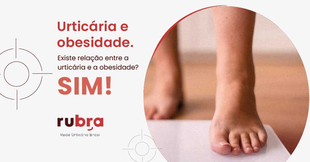 urticaria-e-obesidade